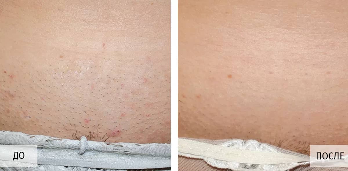 До и после 1 процедуры