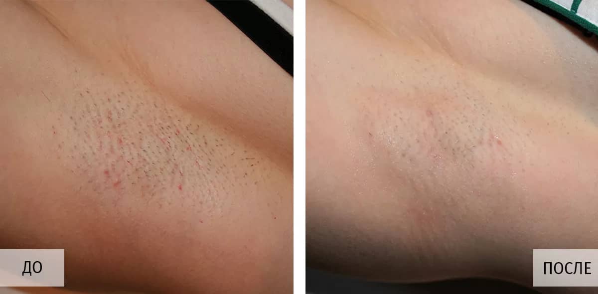 До и после 1 процедуры